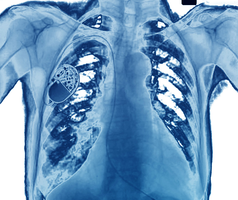 Therapeutics - X-ray of a human chest showing a pacemaker implanted in the left side and abnormal white patches in the lungs.